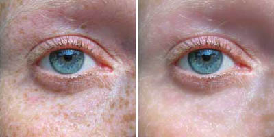 Removing Freckles Tutorial: Final Result