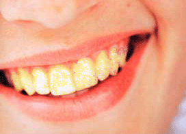 Bad Teeth Tutorial: Final Result