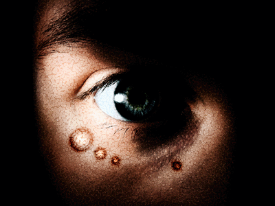 Break Out Zit Photo Retouch Tutorial: Final Result