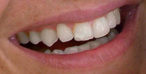Teeth Coloring Tutorial: Final Result