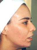 Remove Skin Blemishes Tutorial: Final Result