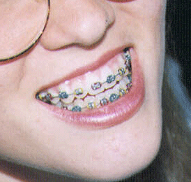 Learn how to remove braces from a smile 1