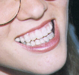 Learn how to remove braces from a smile 5