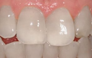 Whitening Teeth the Professional Way