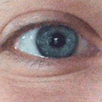 Dilated eye